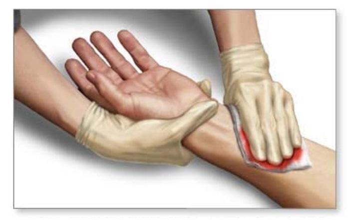 Đứt nhiều ngón tay không chảy máu