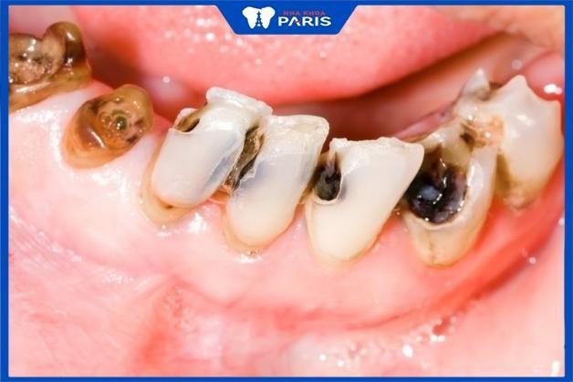 Nằm mơ thấy nhổ răng sâu không đau